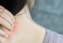 গরমে ত্বকের সুরক্ষায় ঘামাচি প্রতিরোধের উপায়