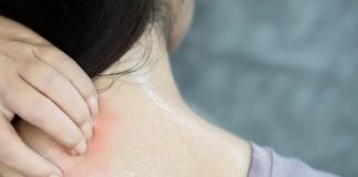 গরমে ত্বকের সুরক্ষায় ঘামাচি প্রতিরোধের উপায়