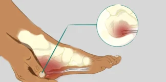 গোড়ালির হাড় বৃদ্ধির কারণ এবং করণীয়