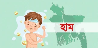 ৯৫ দিনে হাম ও উপসর্গে ঝরে গেল ৬৬৬ শিশুর প্রাণ