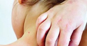 হামের উপসর্গে আরও তিন শিশুর মৃত্যু