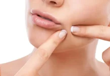 ত্বকে ব্রণ, অবহেলা করলেই বাড়বে বিপদ!